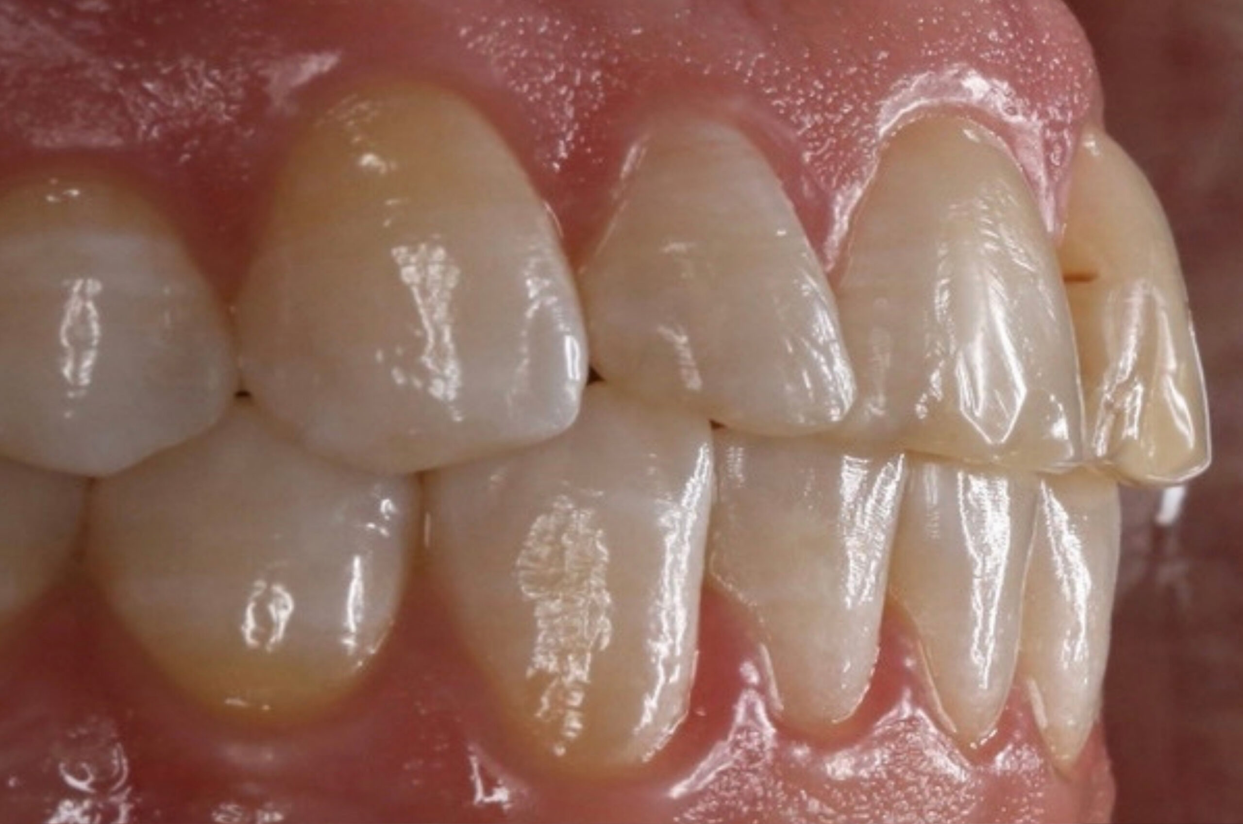 Close-up side view of teeth and gums