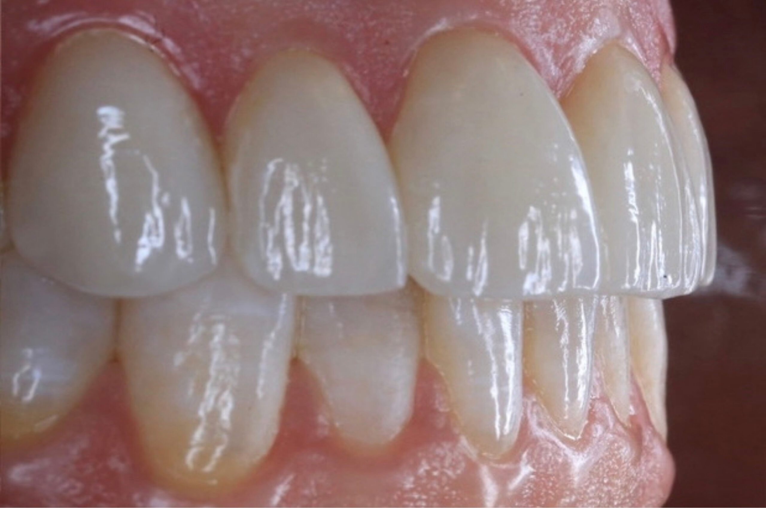 Close-up of upper and lower front teeth