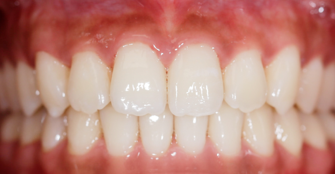 Close-up of healthy straight white teeth