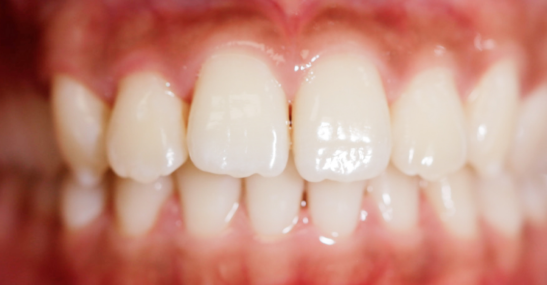 Close-up of healthy white teeth and gums